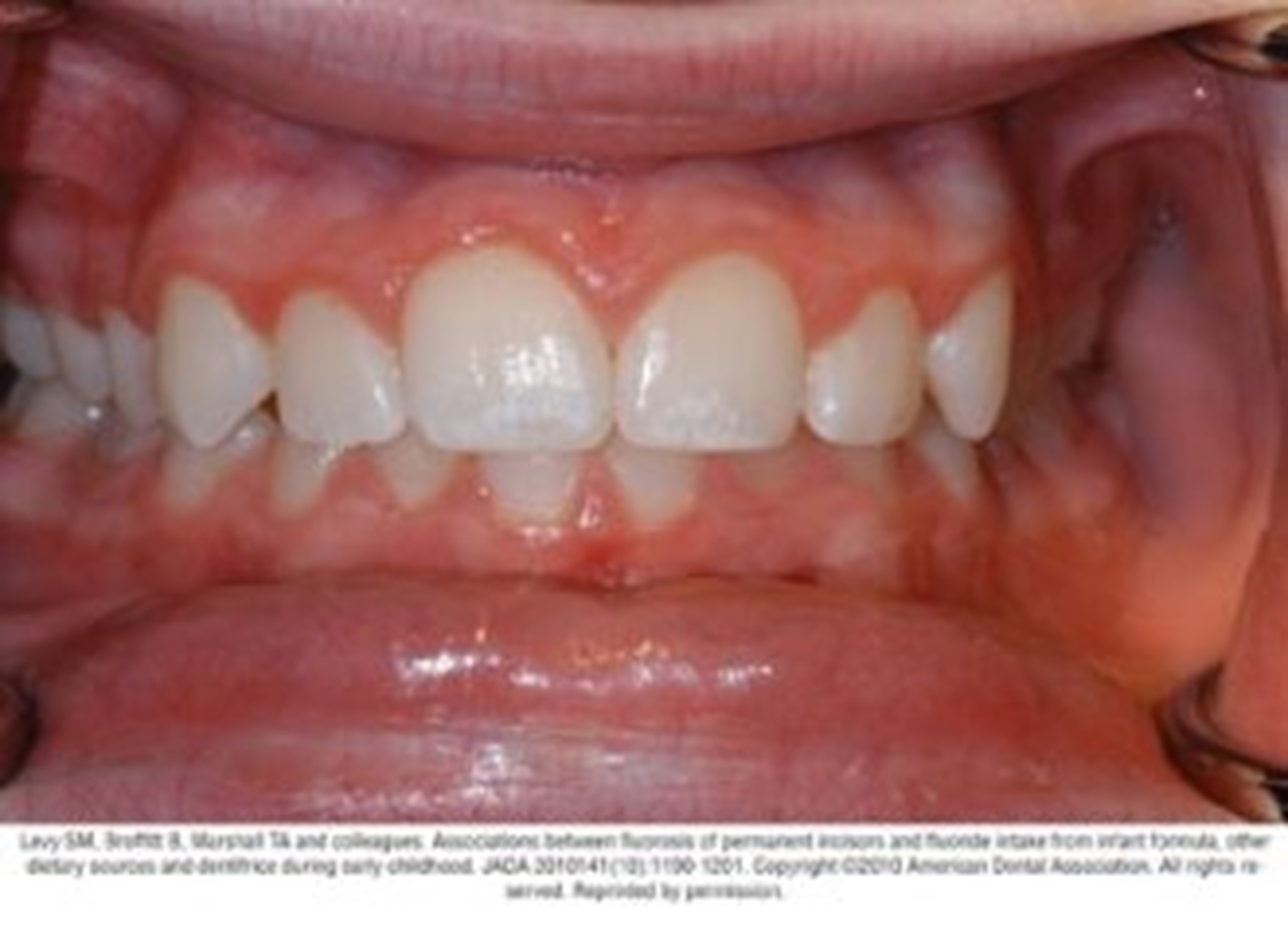Photograph of teeth showing typical case of mild fluorosis