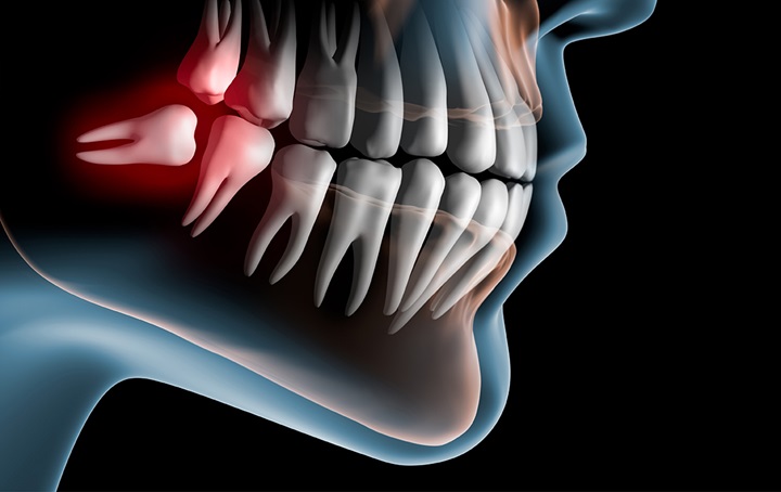 Xray showing impacted wisdom tooth