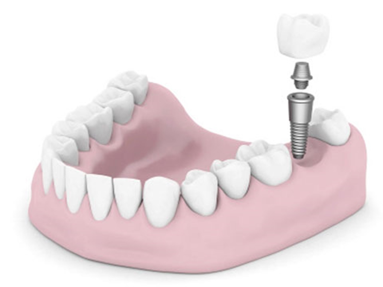 Computer generated 3-D image of a dental implant.