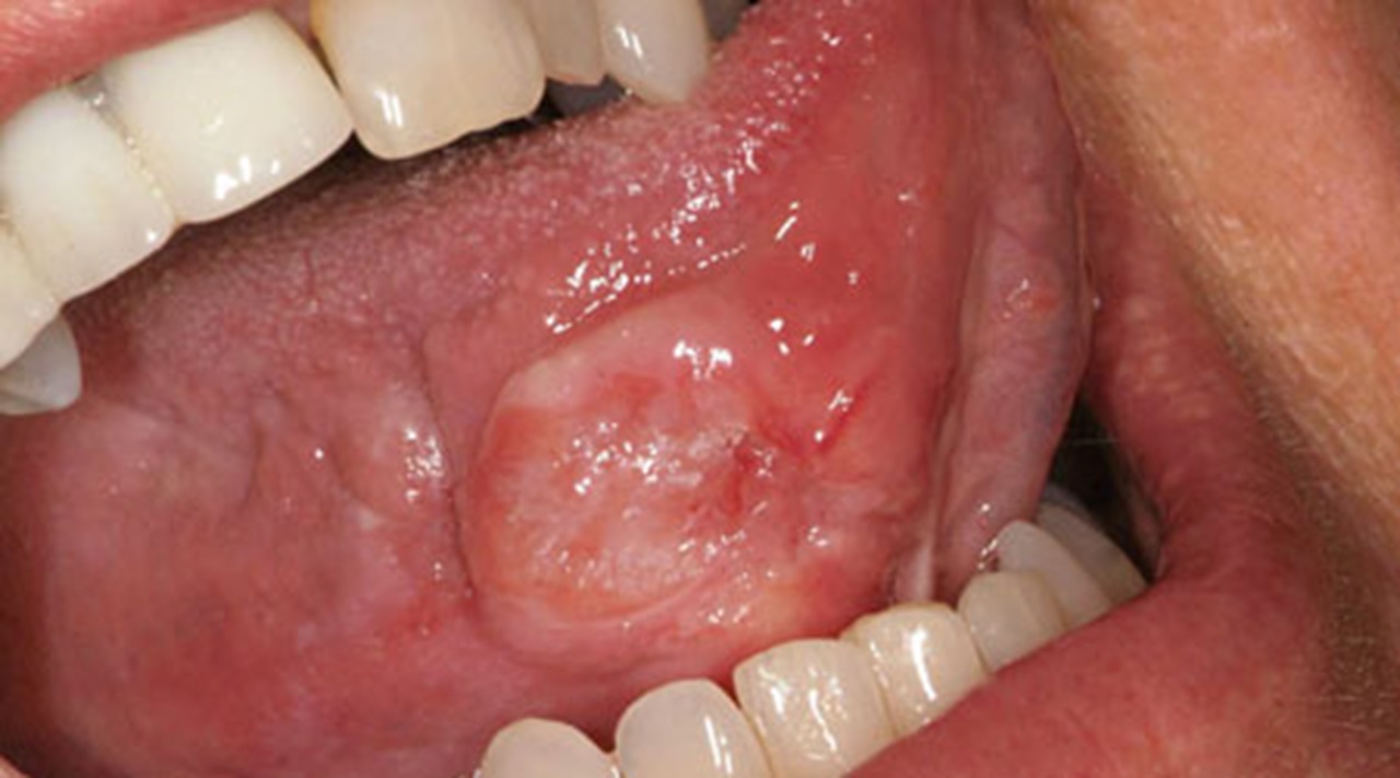Oral cancer