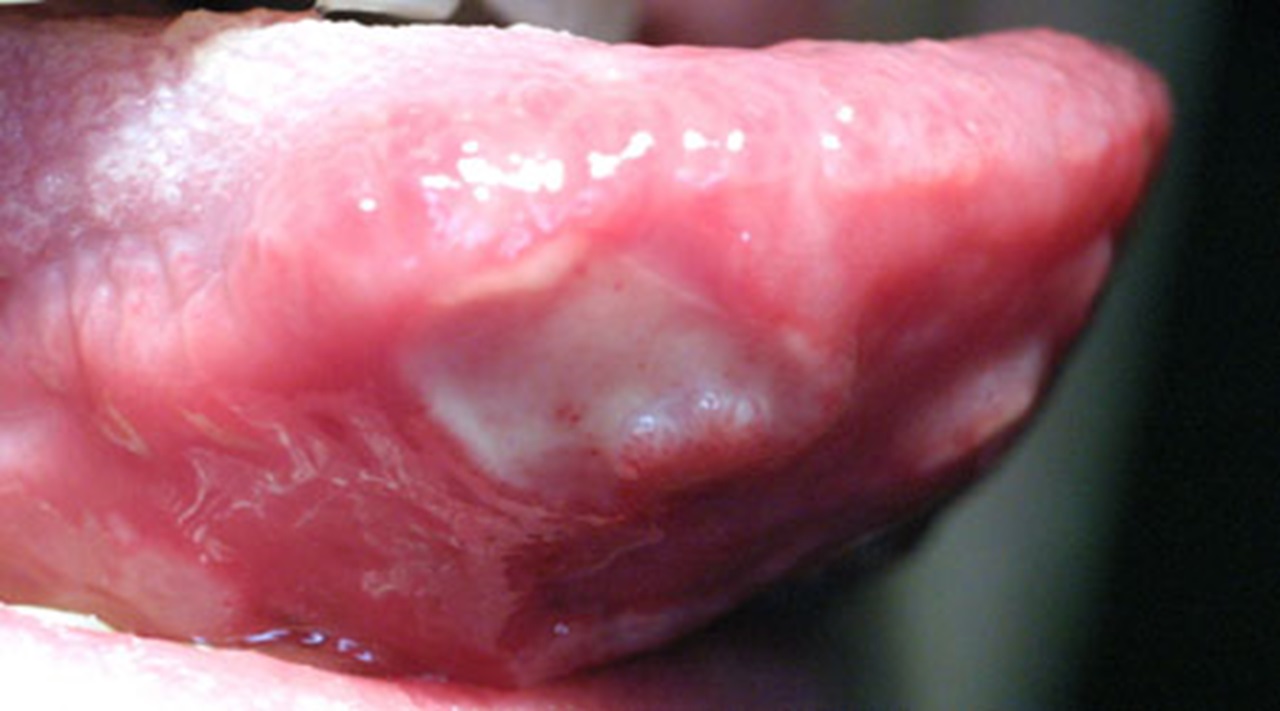 Canker sore