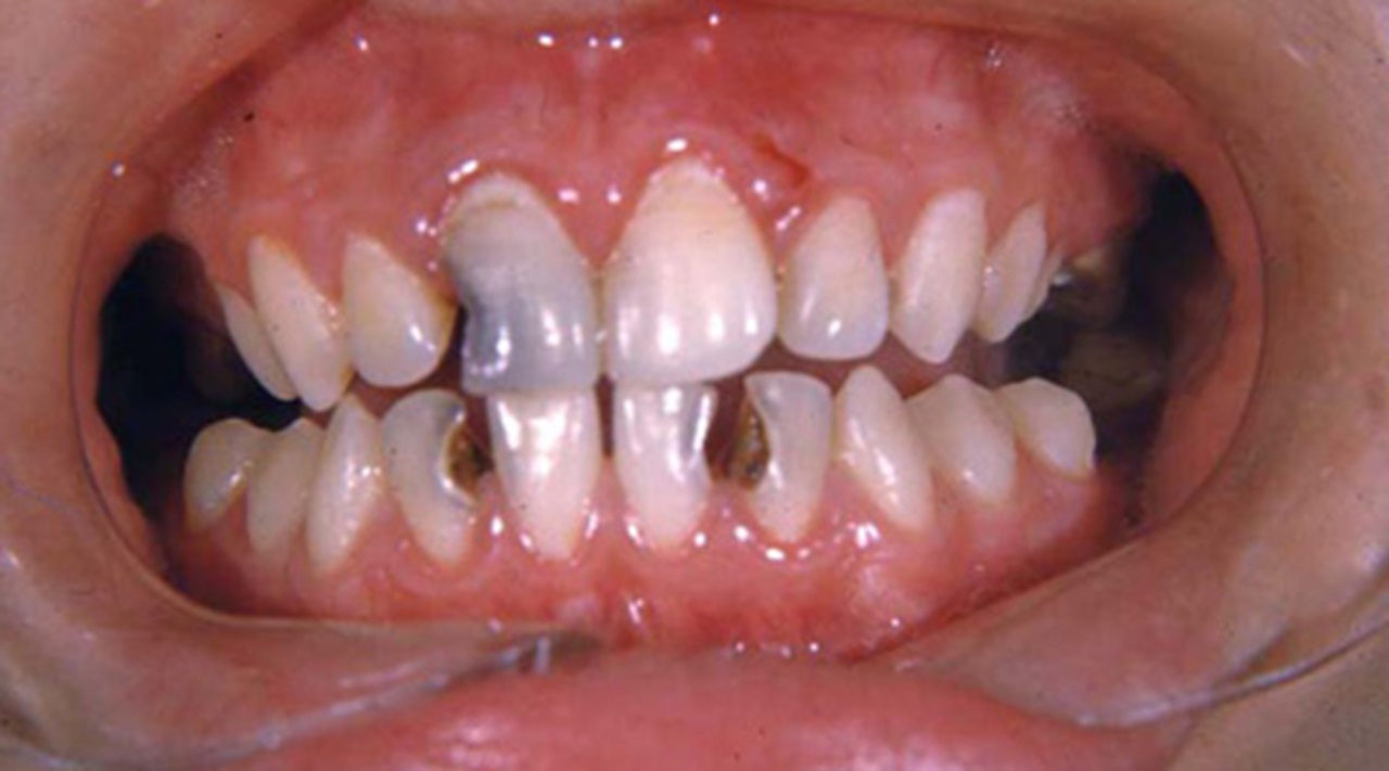 Severe cavities
