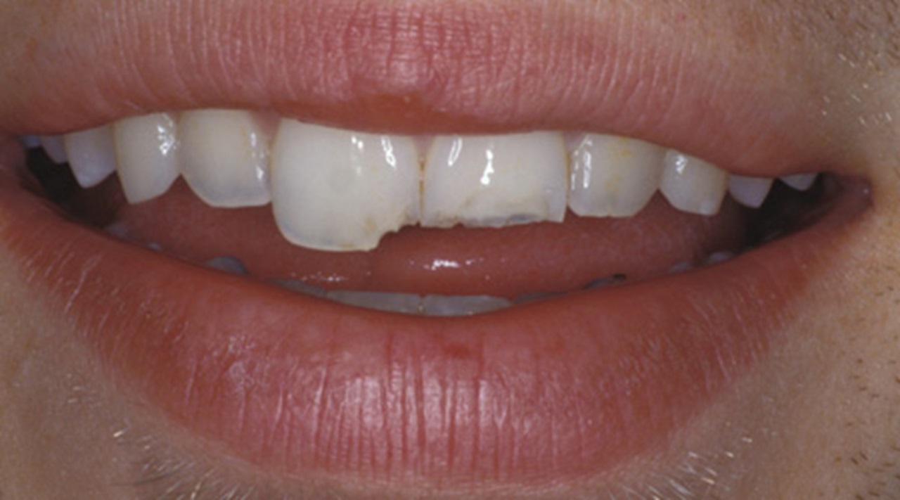 Chipped tooth
