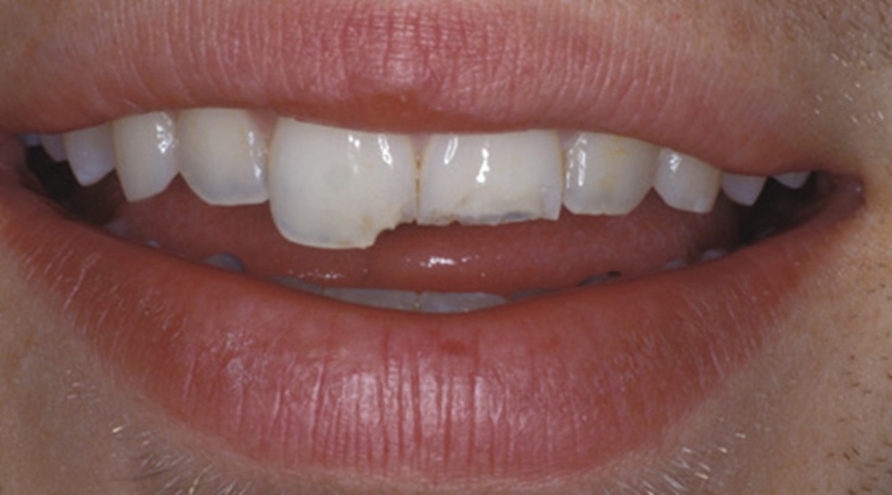 Centrul orasului Inaccesibil răzbunare  Pictures of Common Dental Problems | MouthHealthy - Oral Health Information  from the ADA