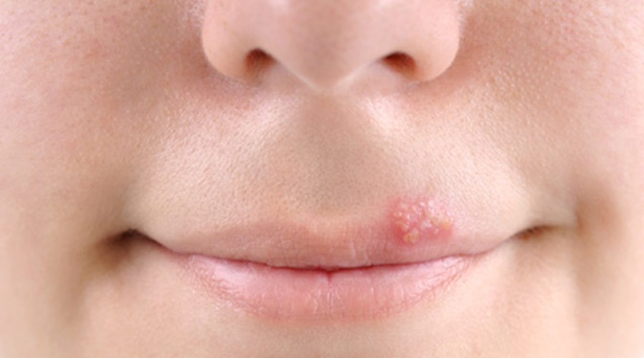 Cold Sore