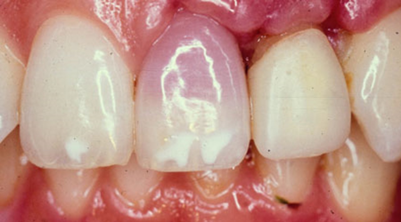 Darkened tooth