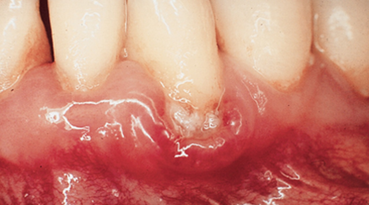 Bleeding gums, gingivitis