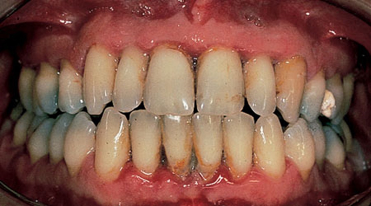 Periodontitis