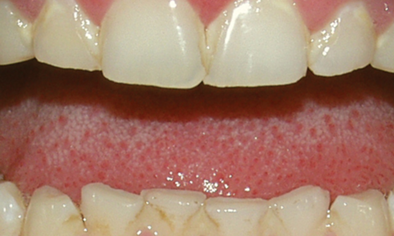Tooth grinding