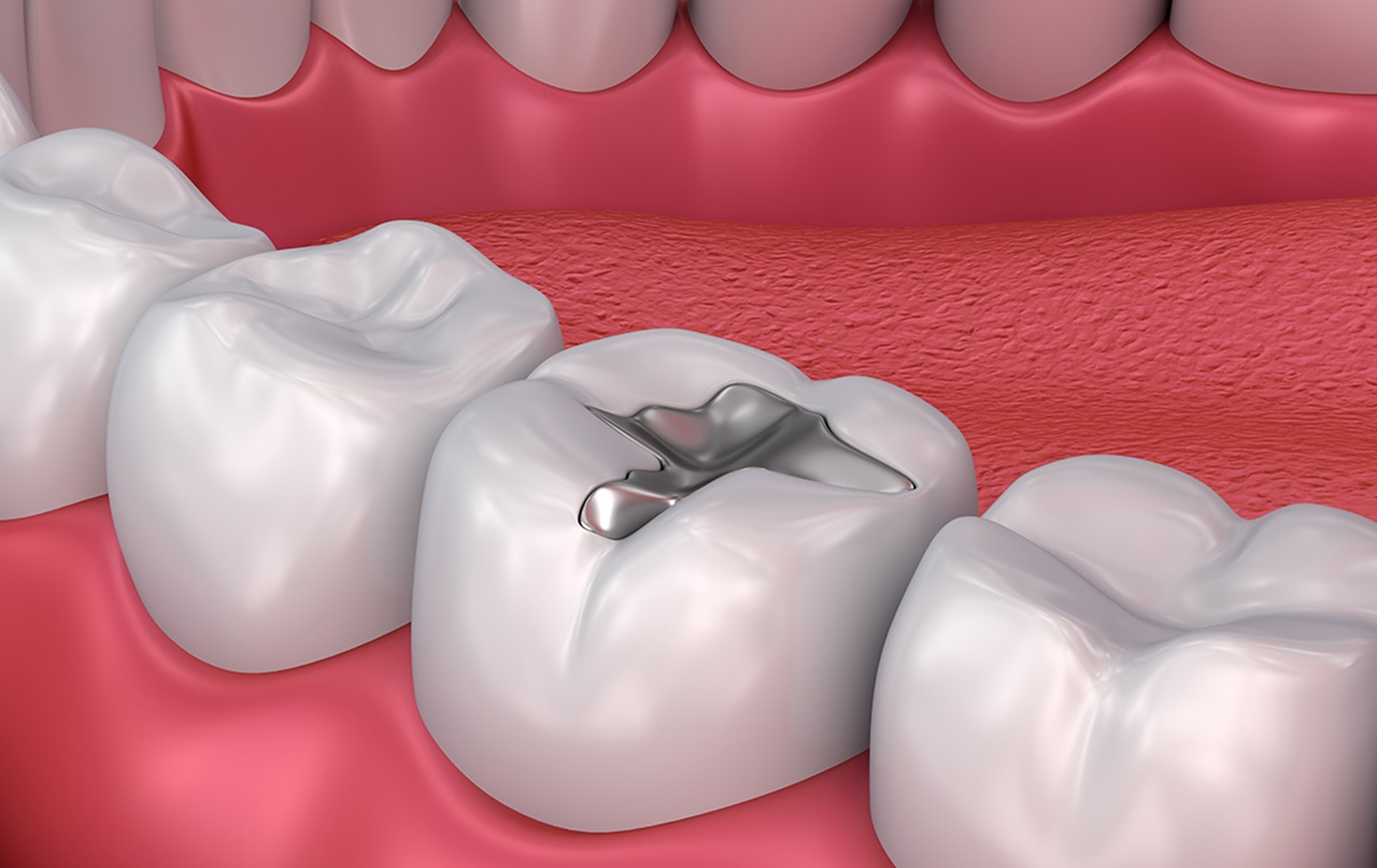 Image of dental amalgam filling 