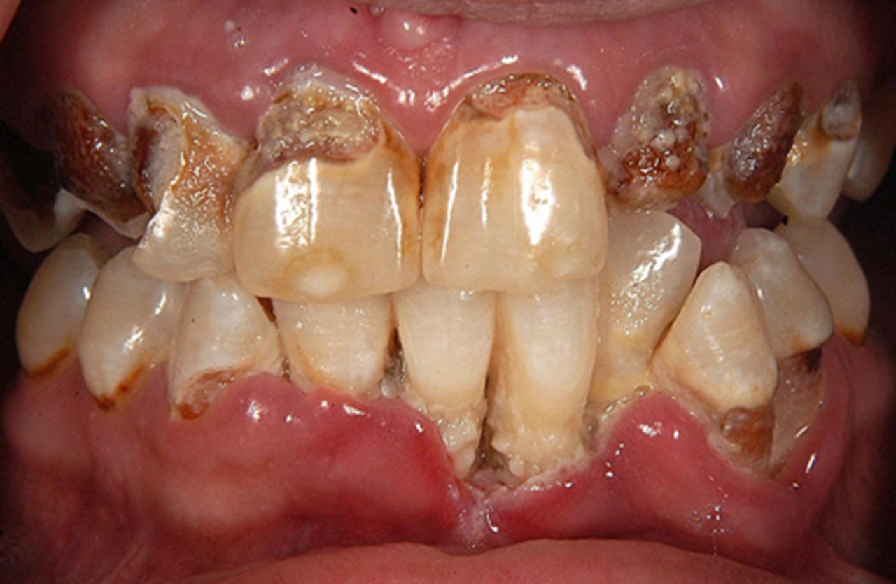  A graphic image of meth mouth.