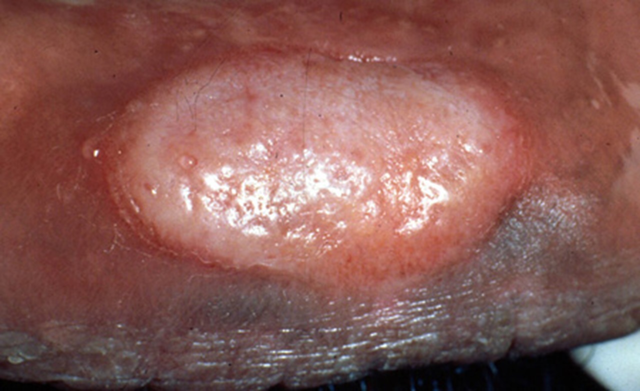 Syphilis in mouth