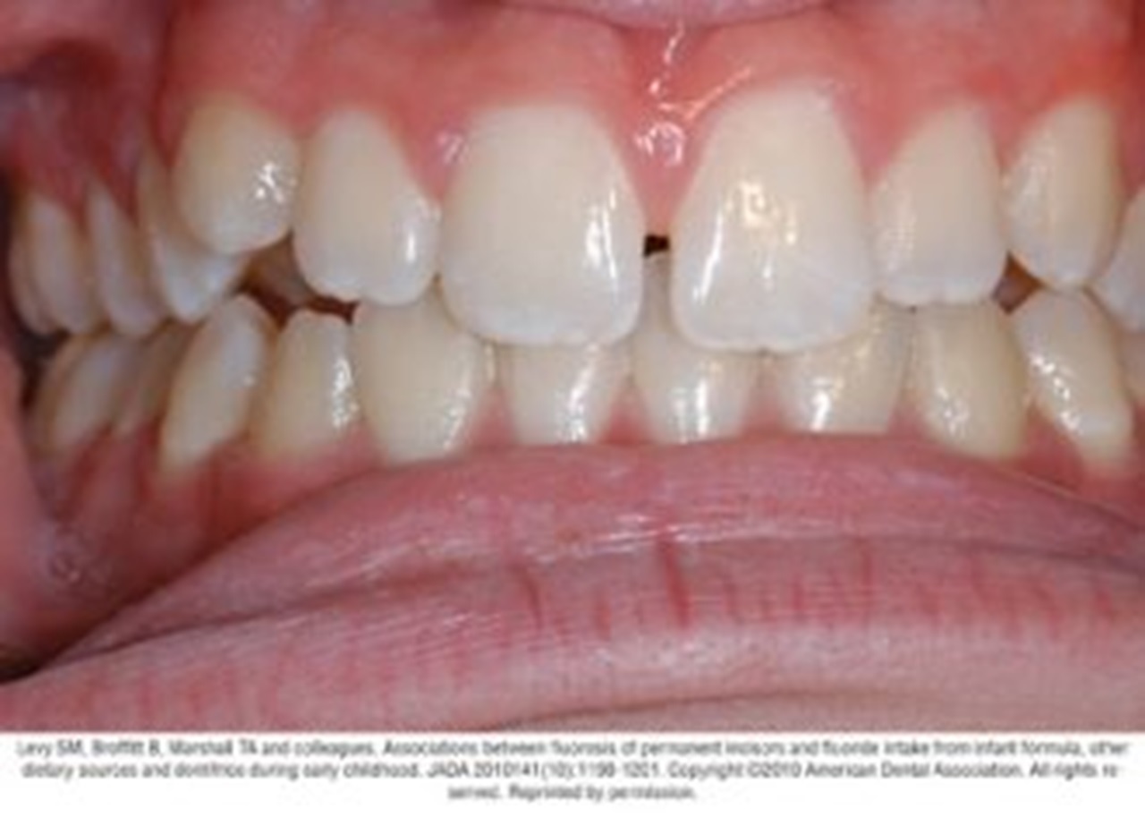 Photograph of teeth showing typical case of mild fluorosis