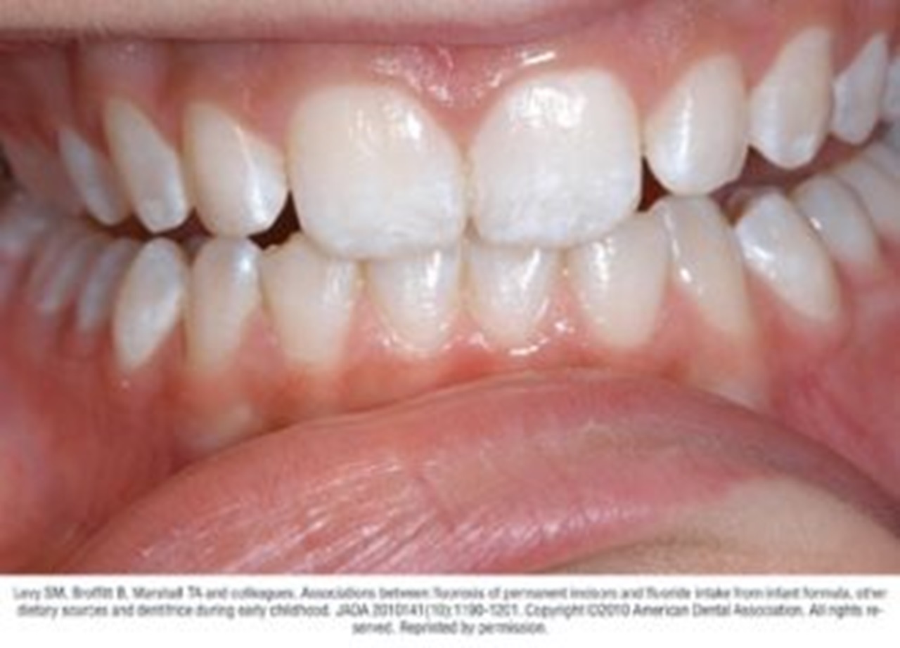 Photograph of teeth showing typical case of mild fluorosis
