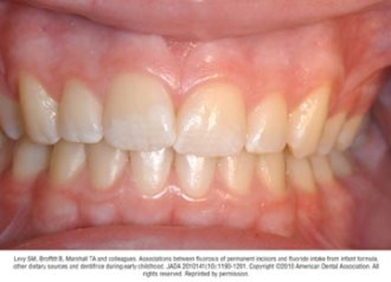 Photograph of teeth showing typical case of mild fluorosis