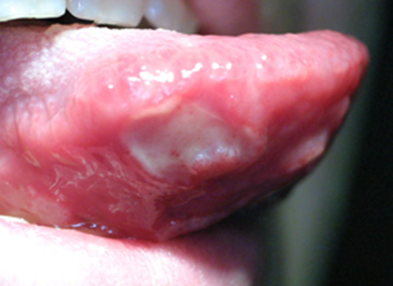 Photo showing sores on the bottom of tongue.