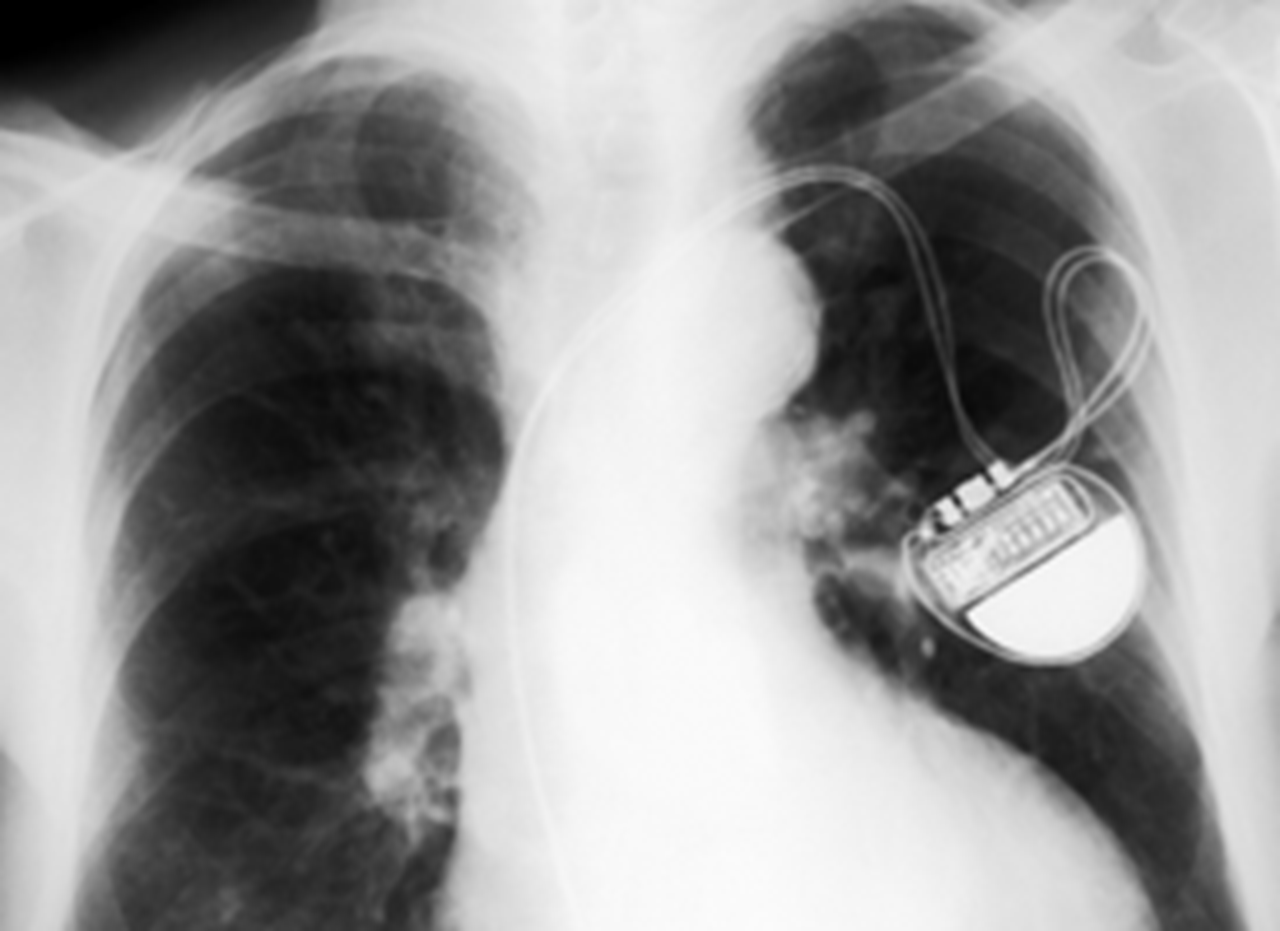 Chest x-ray showing a pacemaker.