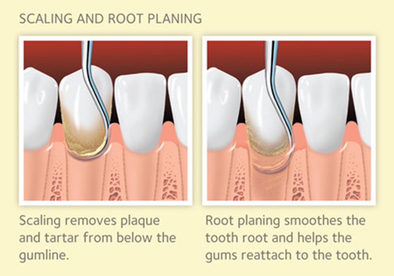 Graphic explaining scaling and root planing dental procedure.
