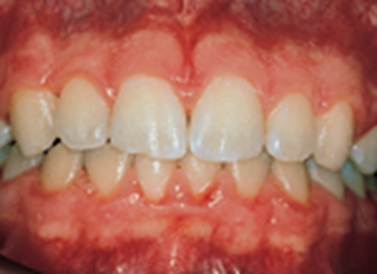 Photograph of gum disease. 