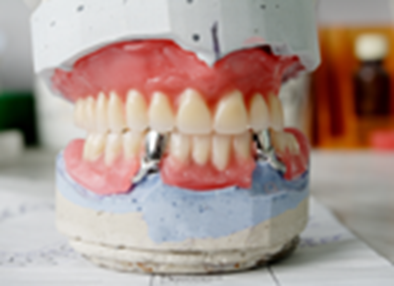 A photograph of dentures on being fitted on a plaster model.