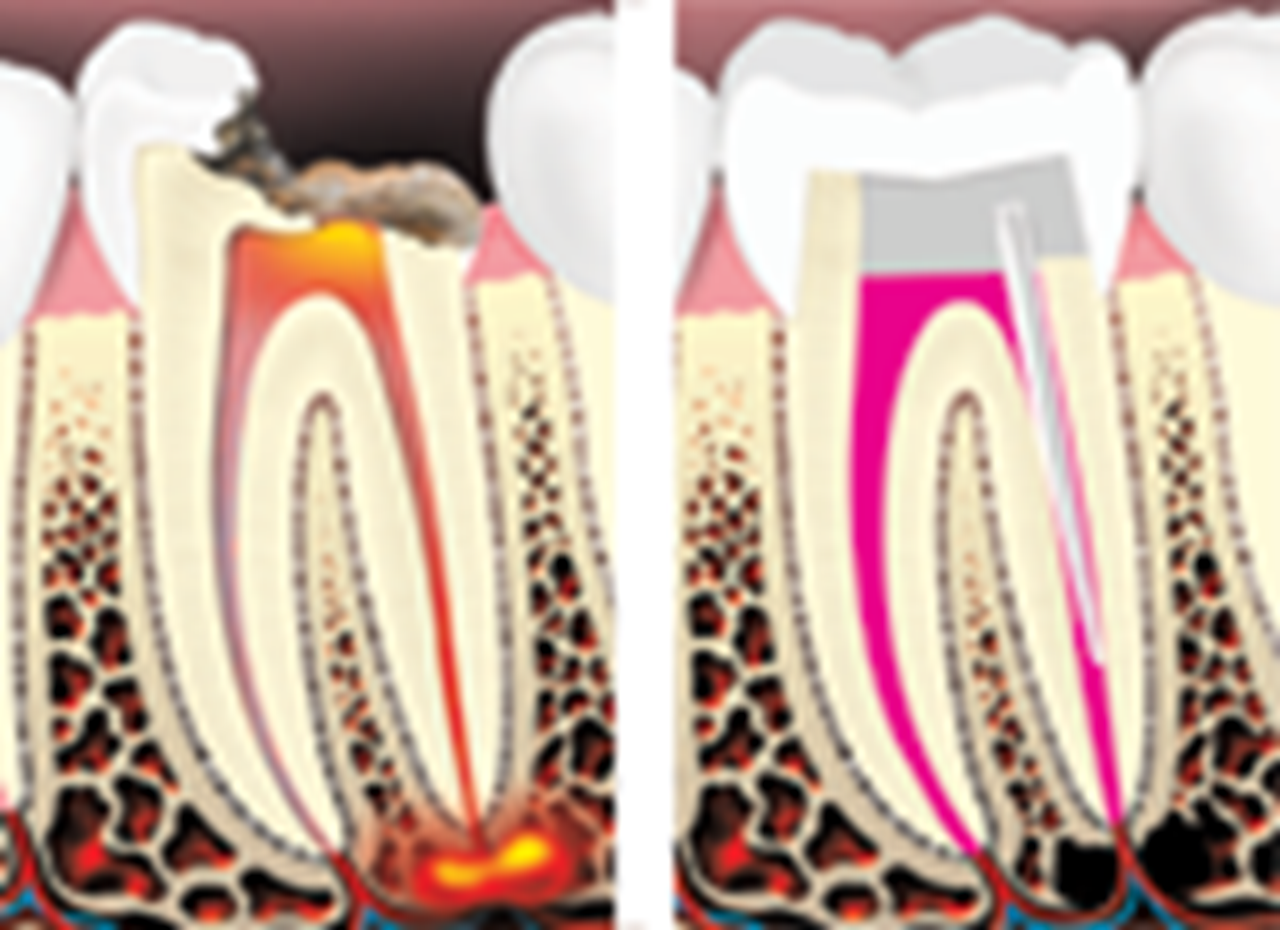 A diagram of a root canal.