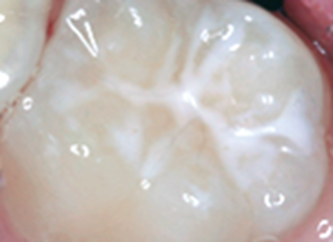 Photo of a molar after sealant has been applied.