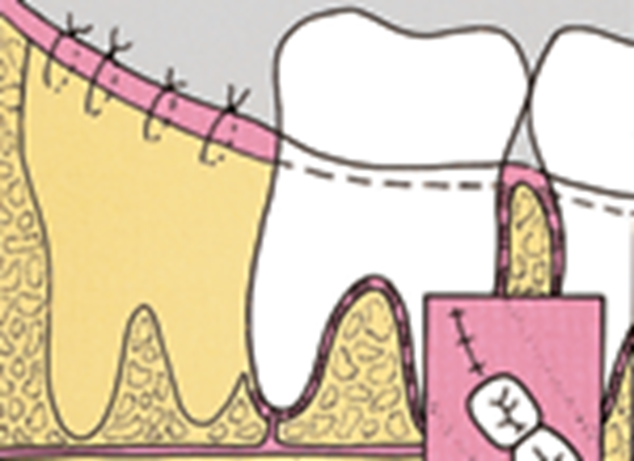 A illustration of wisdom teeth.