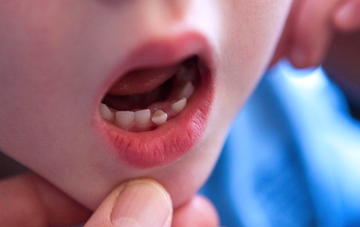 Close up of child's mouth with a loose bottom tooth