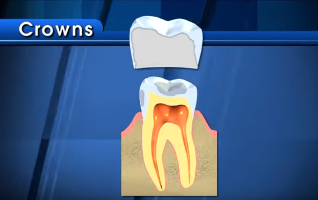 MouthHealthy Graphic shows crown structure