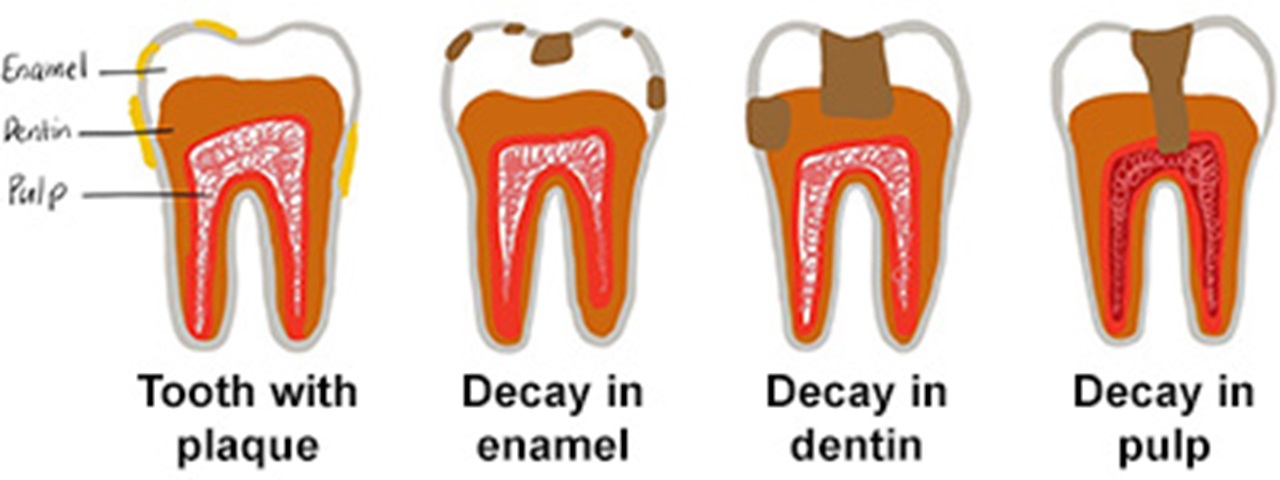 Image of cavity process.