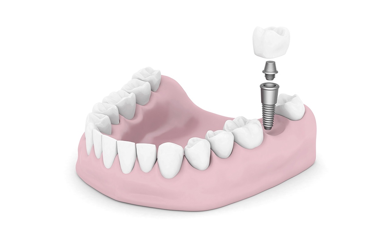 MouthHealthy dental implant