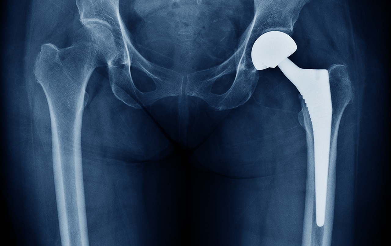 Время операции шейка бедра. Шейка бедра эндопротез. Эндопротезирование тазобедренного сустава рентген. Эндопротезирование шейки бедра. Титановый тазобедренный эндопротез.