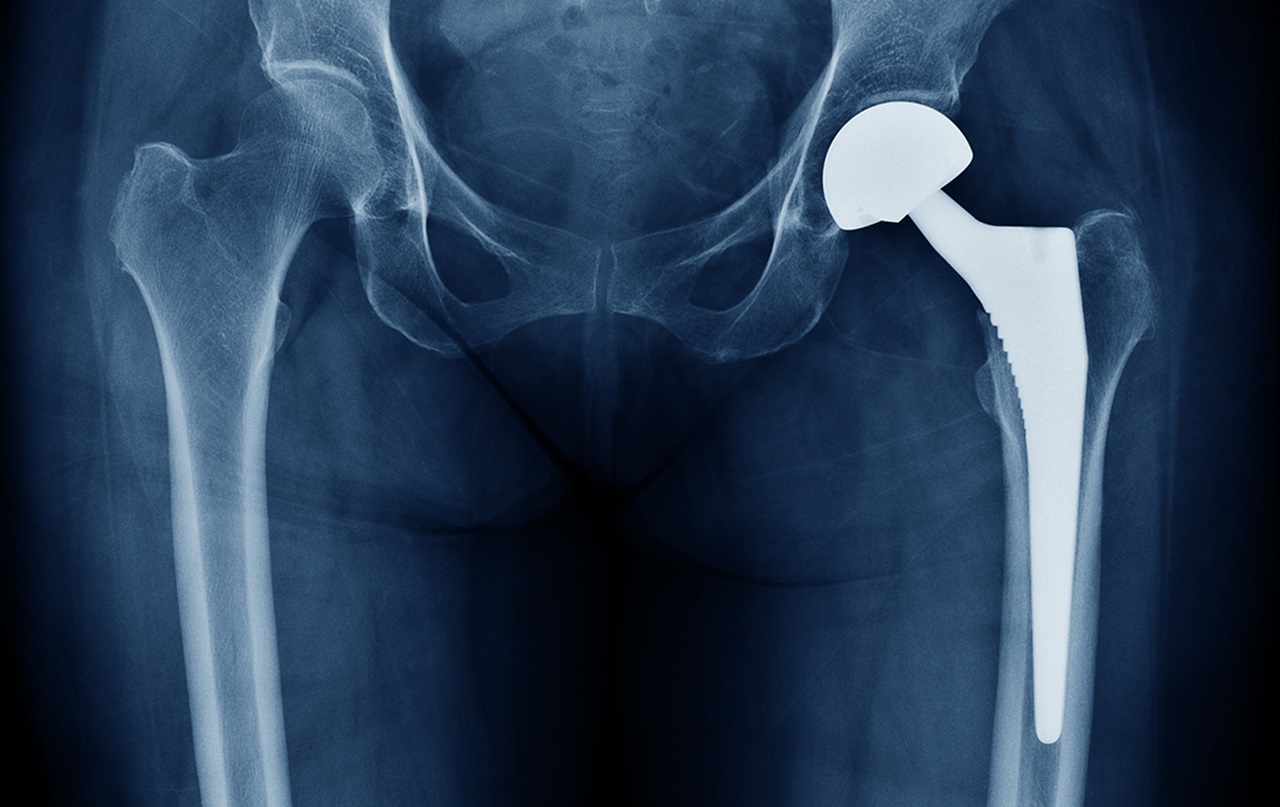 Mouthhealthy X-Ray image of hip joint