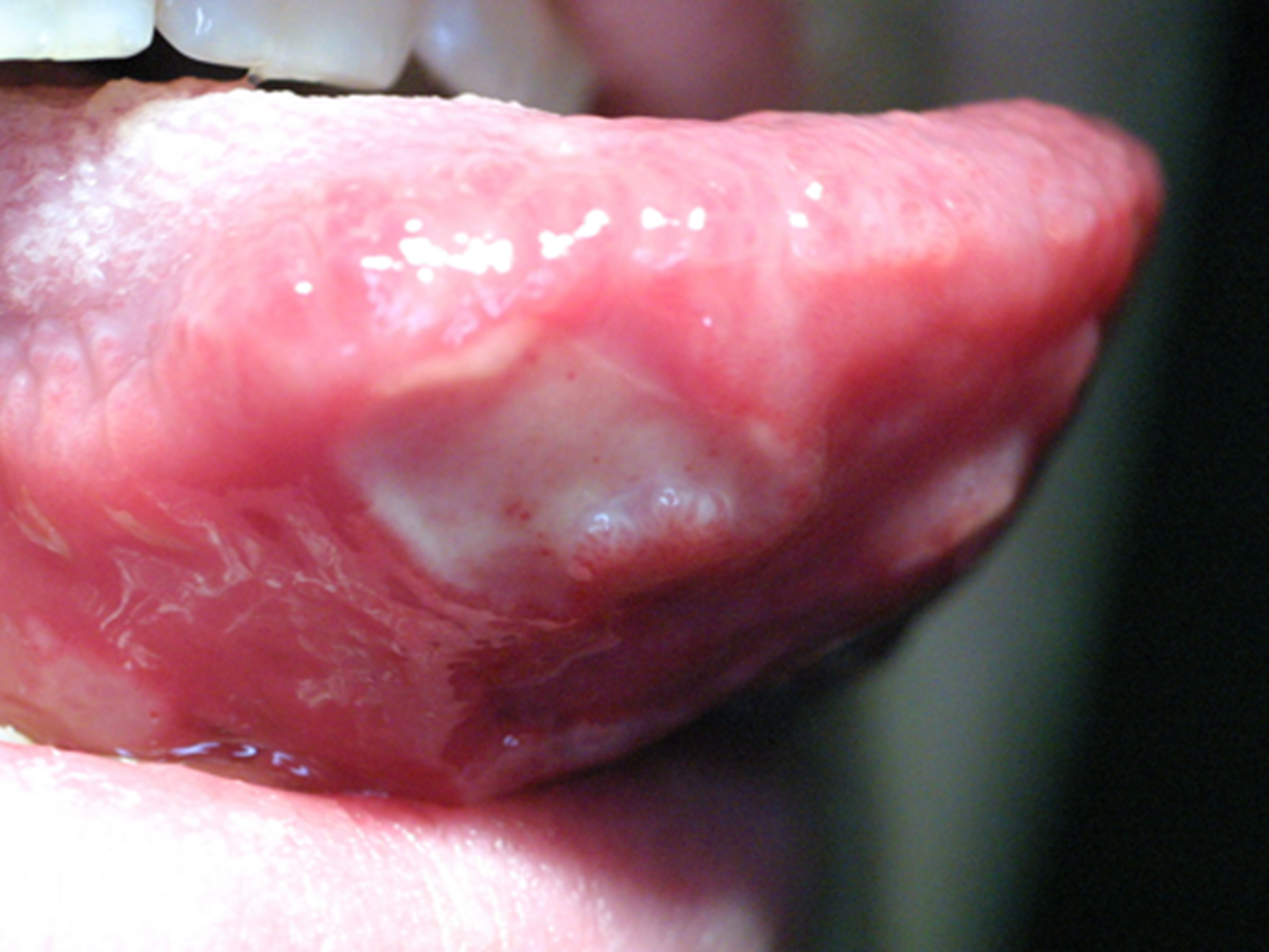 Photo of a sore on bottom of tongue