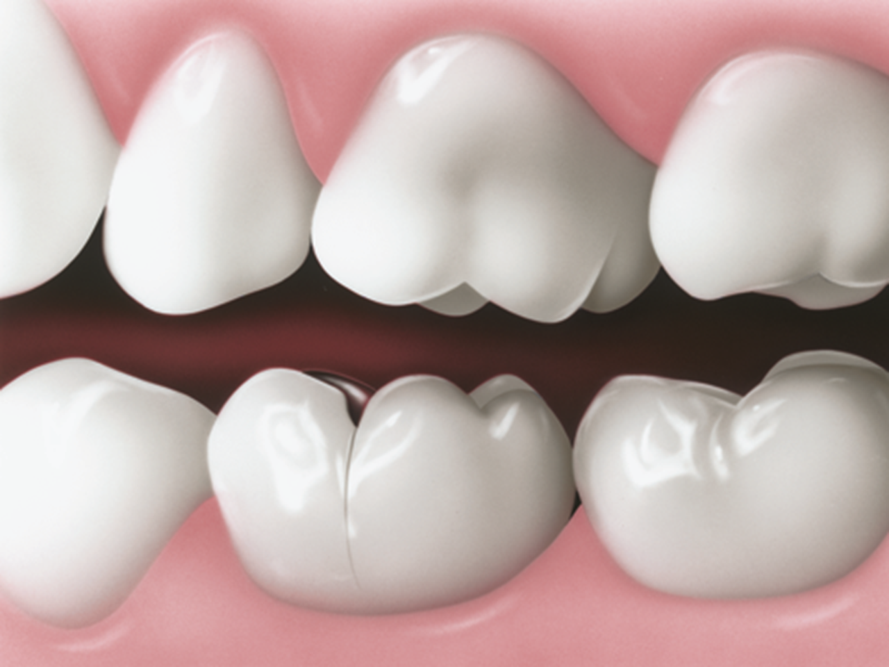 Diagram of teeth showing a small crack in a tooth