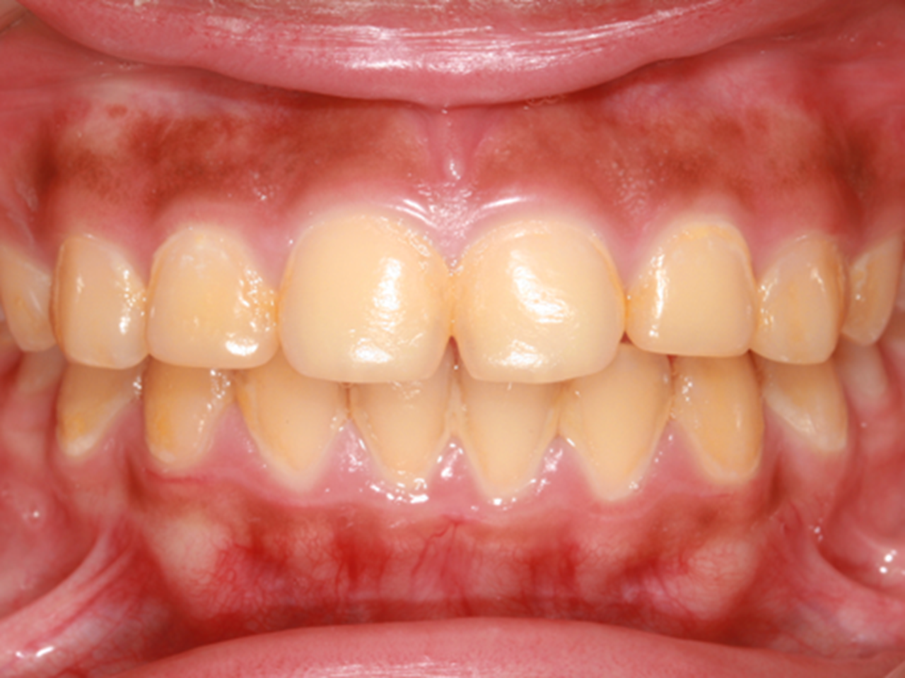 Photo of teeth stained yellow
