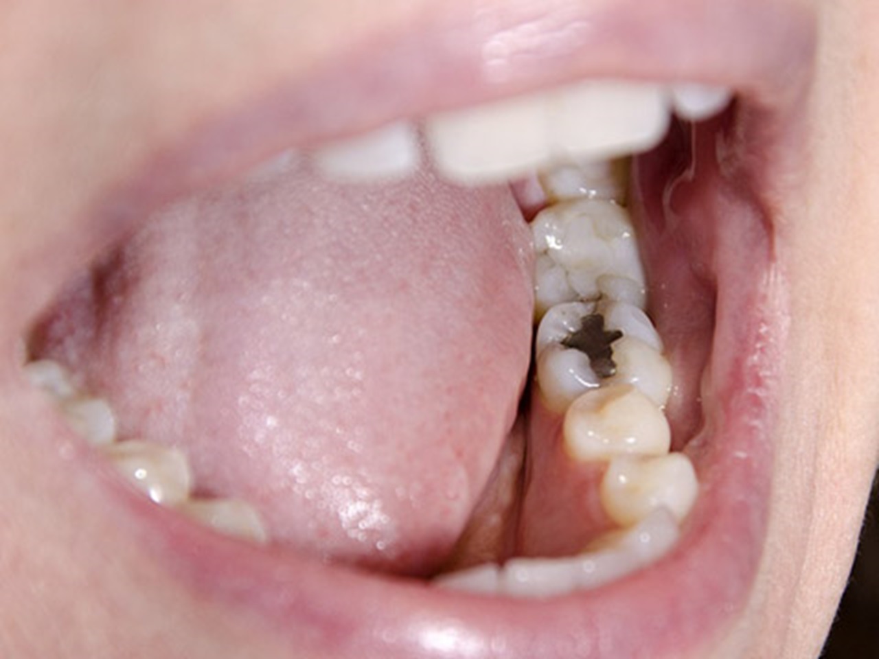 An image of an older filling type.